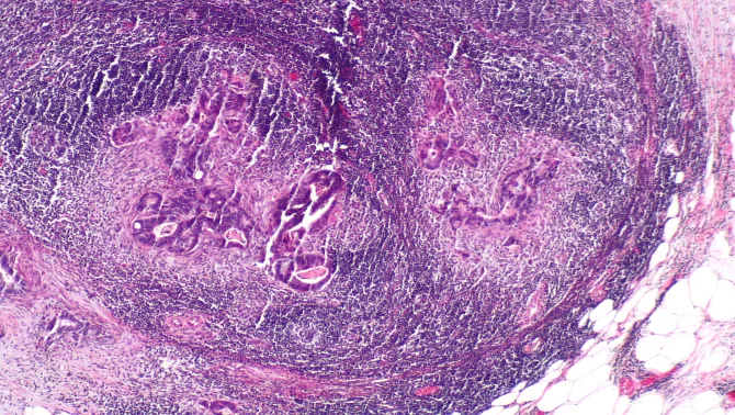 Hallazgo: Identifican las células responsables de la recaída en el cáncer de colon